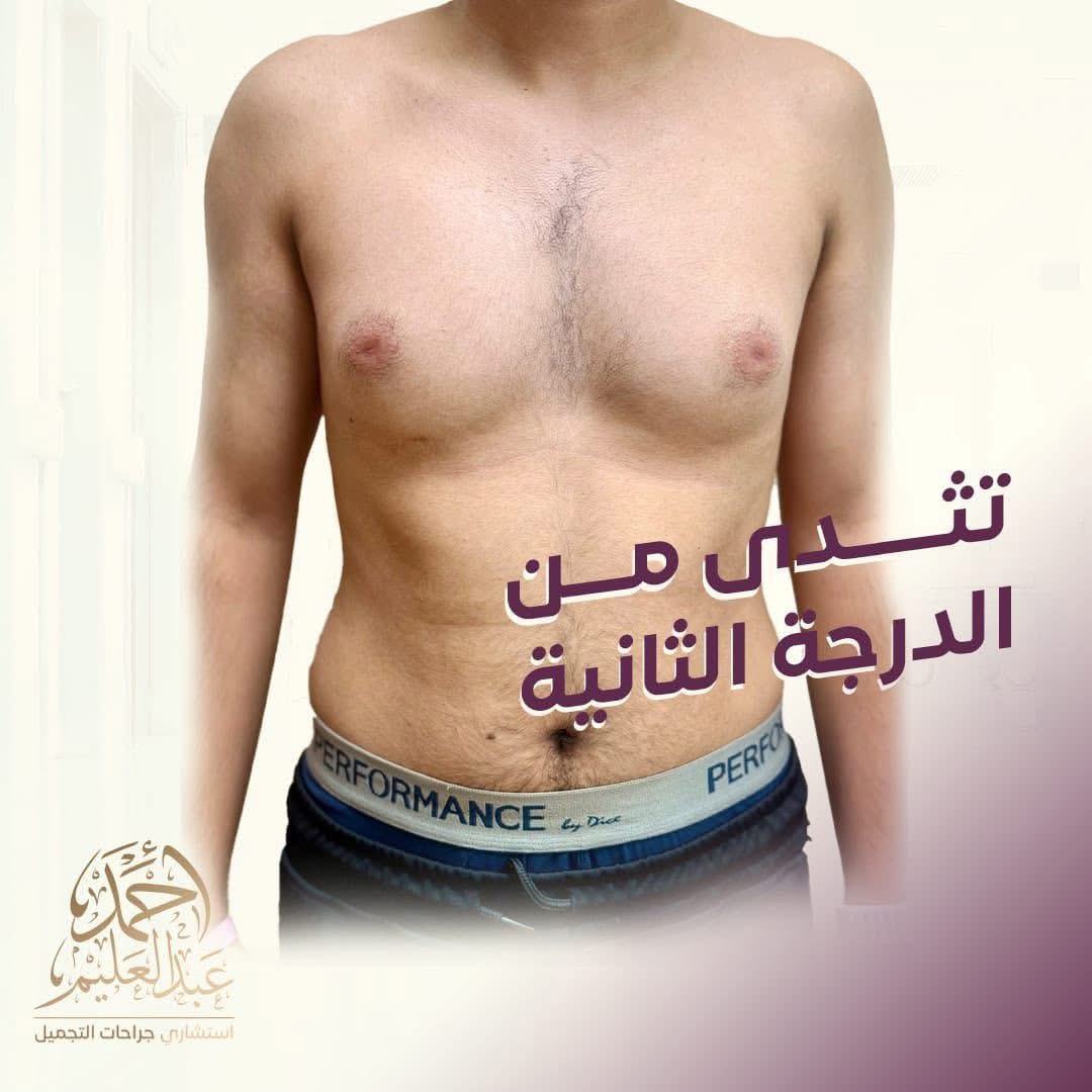 بعد عملية شد البطن