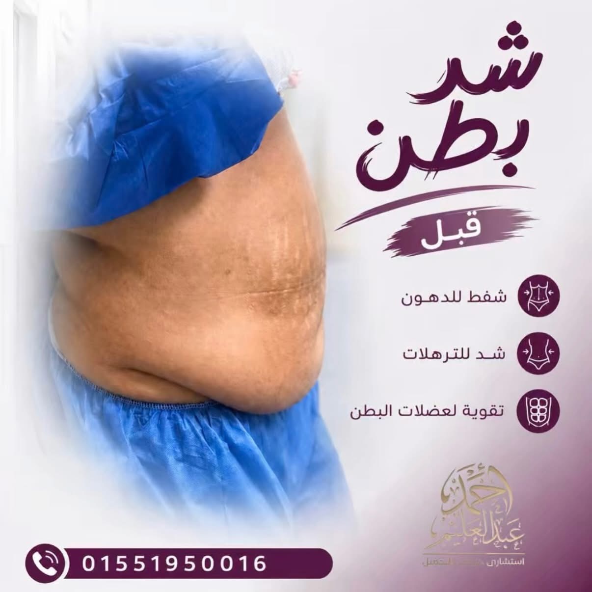 قبل عملية شد البطن